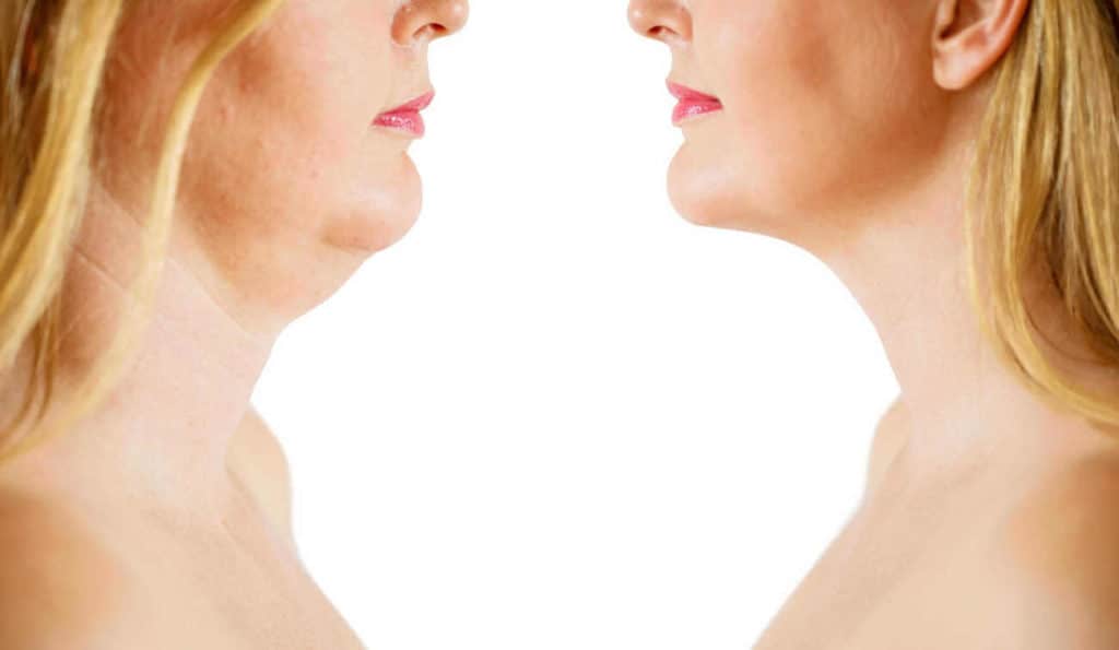 Double Chin treatment St Ives before and after results