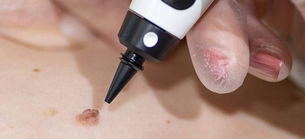 After Skin Tag Removal St Ives