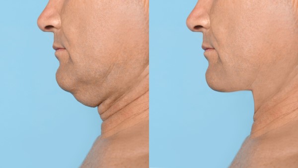 Which Non-Surgical Treatments Work Best for Jowls and Loose Skin St Ives?