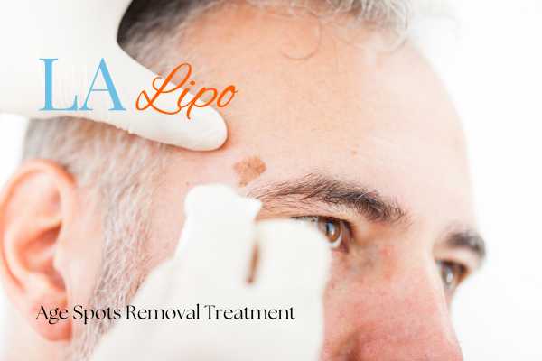 What Are the Most Effective Treatments for Age Spots St Ives?