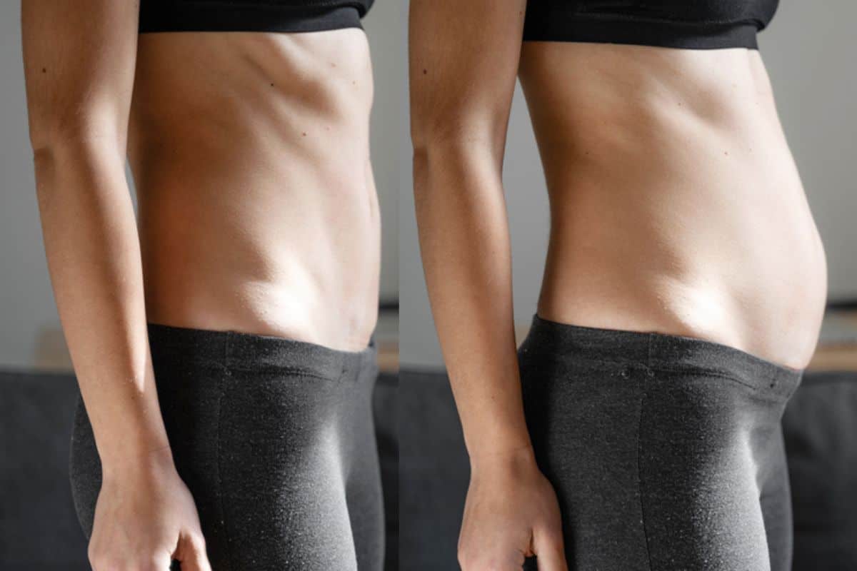 How long does diastasis recti take to improve St Ives?