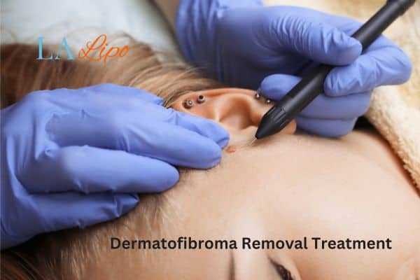 Dermatofibroma Removal Treatment St Ives