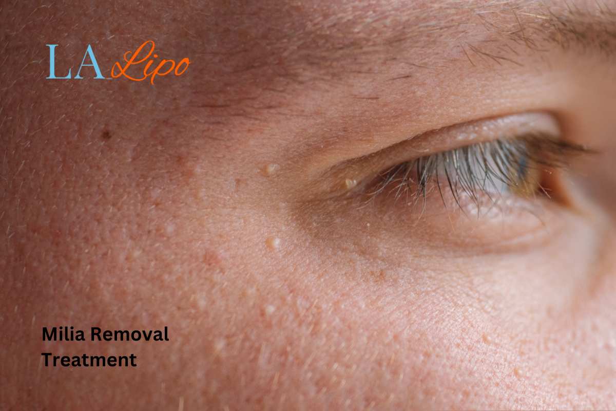Cryopen Milia Removal: Is It the Easiest and Safest Option St Ives?