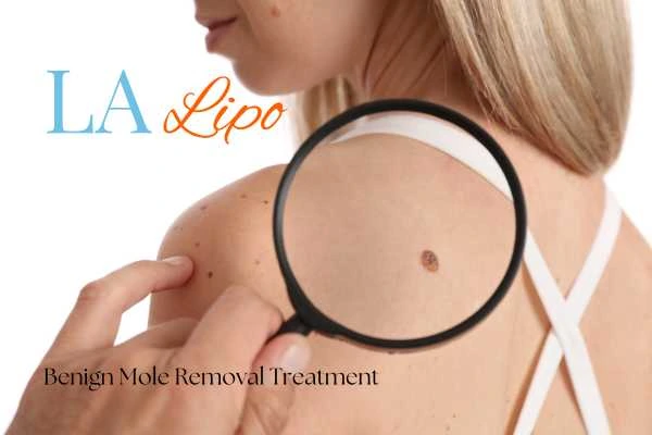 Why getting moles removed St Ives can boost your confidence!