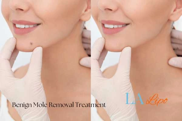 Woman's before and after results of being moles removal treatment St Ives