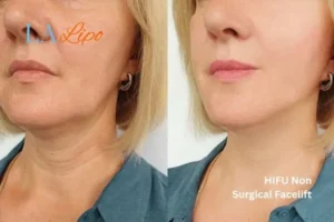hi-fu for wrinkles St Ives before and after results