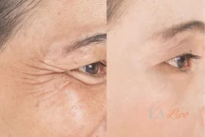 Before and after results of woman - HI-fu wrinkles reduction treatment St Ives
