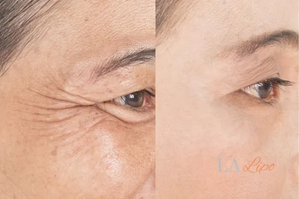 Before and after results of woman - HI-fu wrinkles reduction treatment St Ives