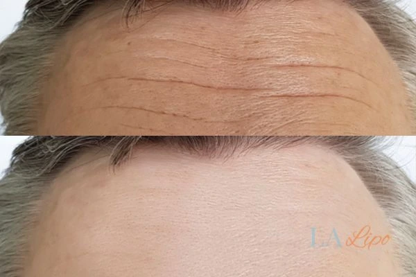 results of HIFU St Ives on mans forehead to help reduce lines and wrinkles