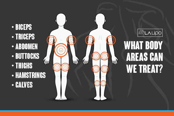 Graphic to show areas you can have LA-EMS Body Sculpting St Ives treatment.