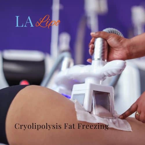 fat freezing - Cryolipolysis St Ives