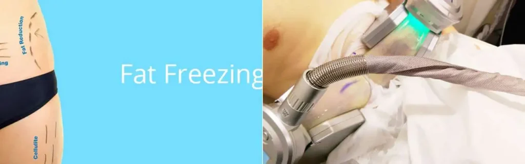 multi areas of a persons body having coolsculpting St Ives treatment
