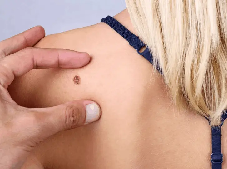 woman having mole removal St Ives consultation before treatment.