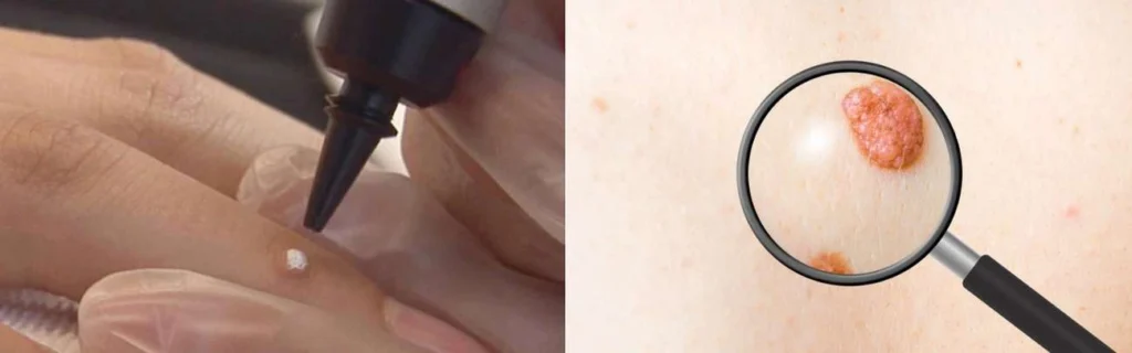Person getting moles removed with cryopen St Ives