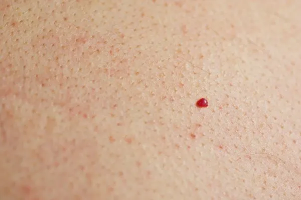 close up of a cherry angioma St Ives