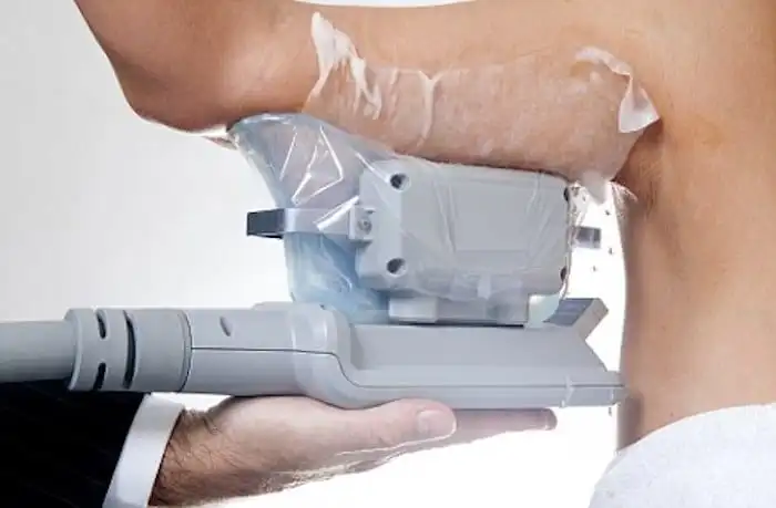 Picture of fat freezing St Ives on the upper arms.