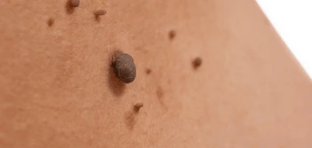 image of a skin tag St Ives