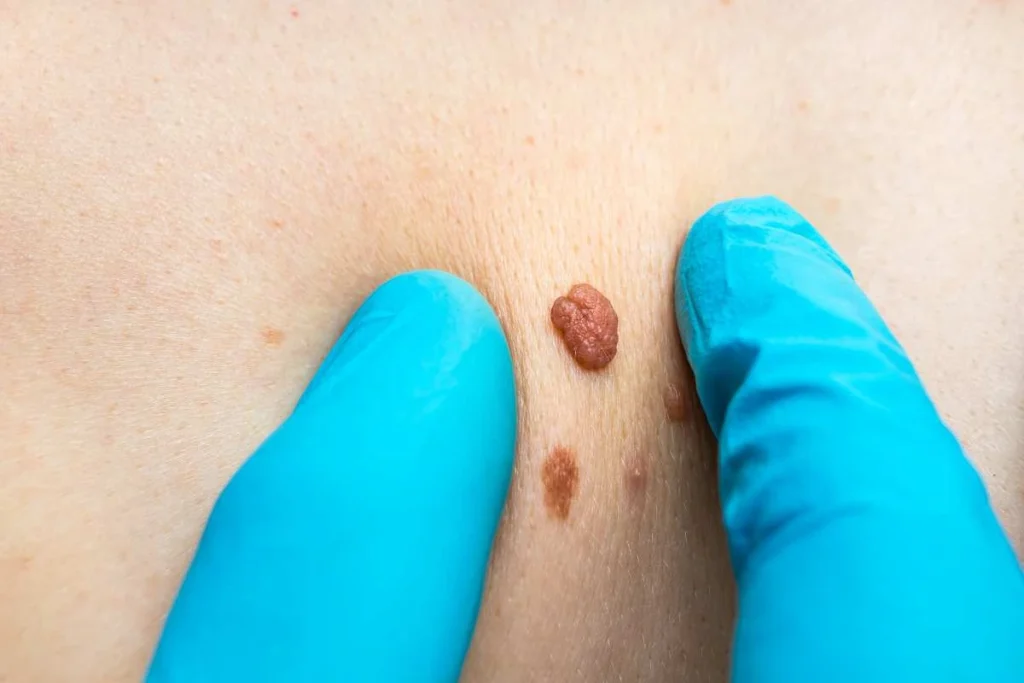 Consultant examining a skin tag St Ives