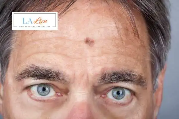 Solar Lentigo Removal St Ives image of man with mark on his forehead