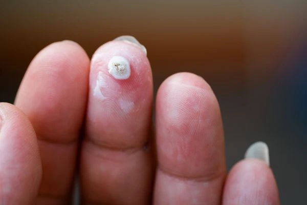 wart on person finger - cryotherapy to treat from LA LIPO St Ives