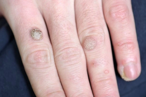 photo of warts on person hand - see wart removal St Ives from LA LIPO
