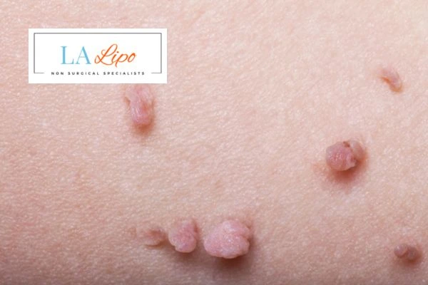 Does cryopen skin tag removal St Ives hurt? Find out now call our team today!