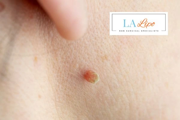 Book skin tag removal St Ives today speak to our team now!