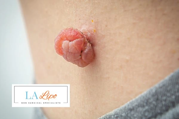 Interested in skin tag removal St Ives? Concerned about the pain? Find out more today!