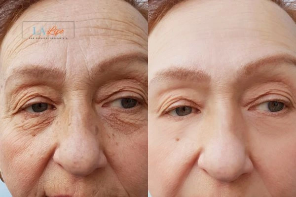 The powerful benefits of Morpheus8 Treatment St Ives - Call Our team today!