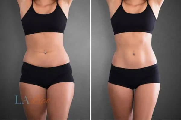 before and after results of non-surgical treatment to help a woman's body image and mental health St Ives