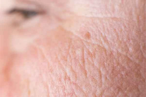close up picture of a woman's face showing an age spot St Ives