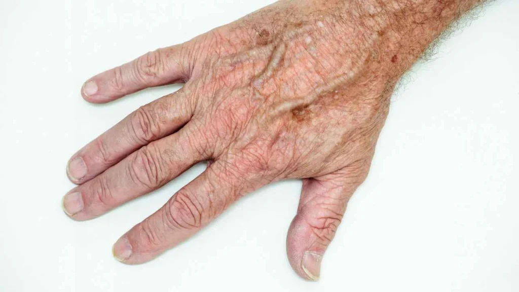 Male hand showing age spot St Ives