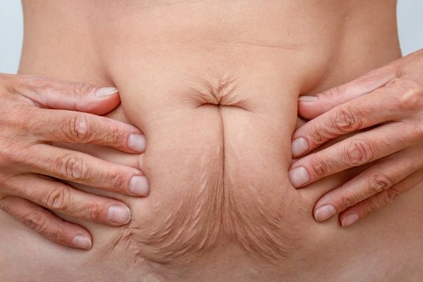 Image of a woman's stomach with loose skin - example of skin tightening St Ives options