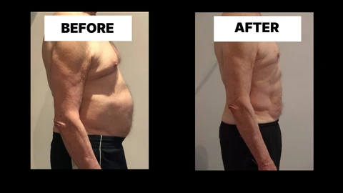 What Symptoms Can Diastasis Recti Cause in Men? Weak Core, Back Pain and Poor Posture St Ives
